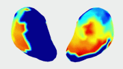 3D Maps of Uterine Contractions During Labor