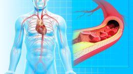 Atherosclerosis