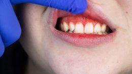 Bleeding Gums Gum Disease