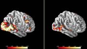 Brain scans could help doctors find treatments for people with social anxiety disorder