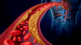 Clogged Artery Atherosclerosis Disease