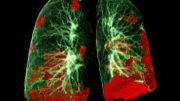 COVID-19 Patient Lung Damage