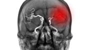 CT Scan Brain Bleed Stroke