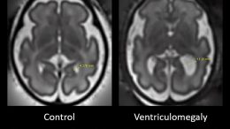 Fetal Brain Scan Early Indicators of Autism