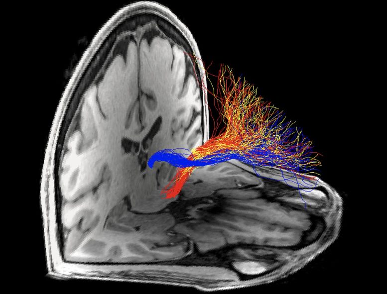 Human Cocaine and Heroin Addiction Brain Circuit