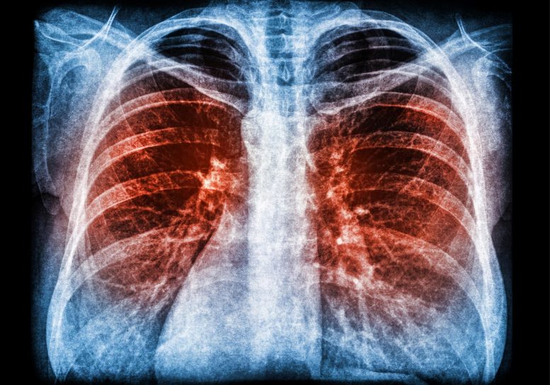 X-Ray Scan Pneumonia Lung Infection